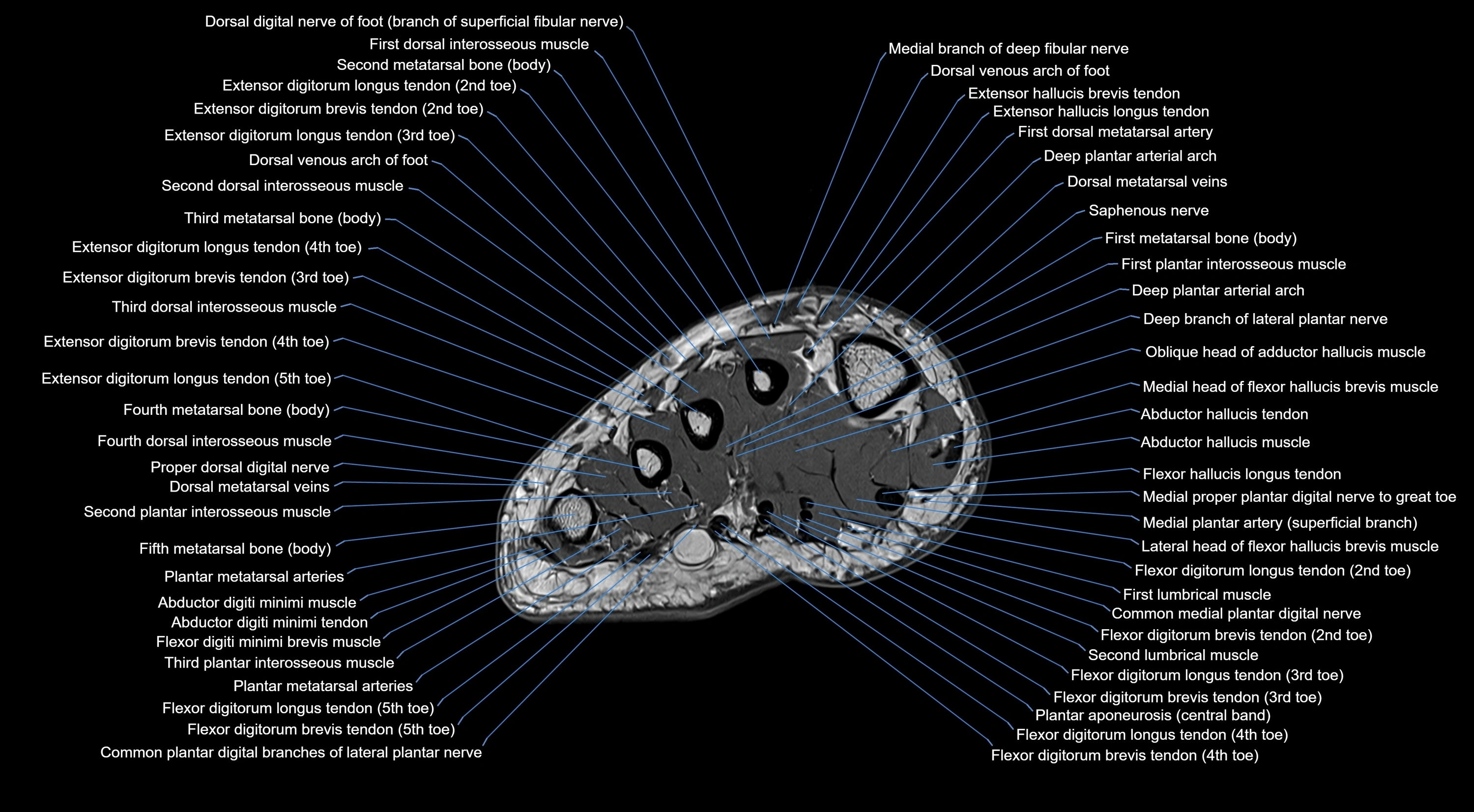 MRI mid foot coronal ligaments cross sectional anatomy 3T  radiology  image-img-00001-00001.webp
